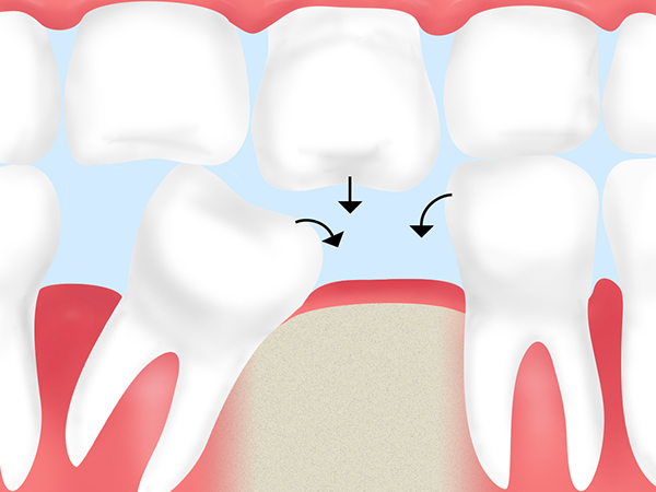 失った歯を放置しておくと発生するリスク
