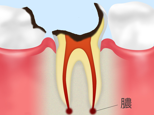 虫歯を放置しておくと、こんなに危険です
