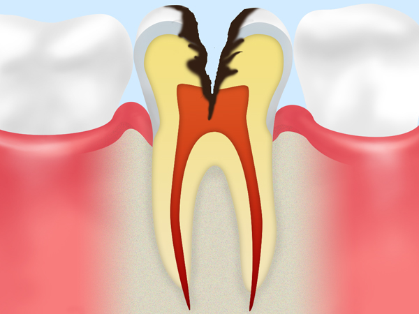 C3【神経の虫歯】