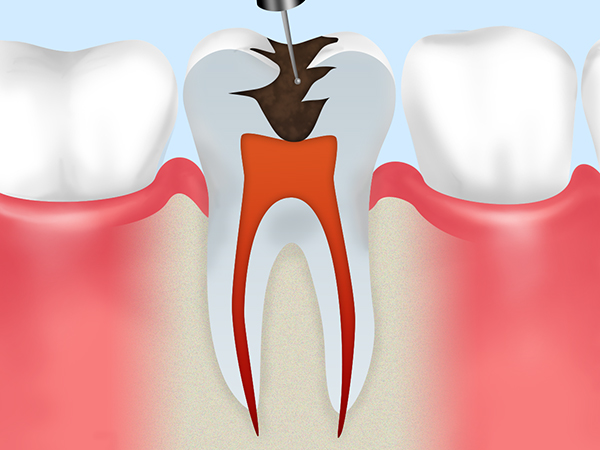 重度の虫歯から歯を残す「根管治療」
