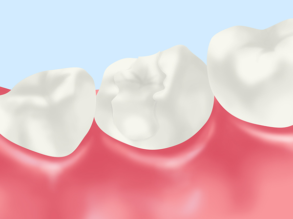 詰め物・被せ物の修正